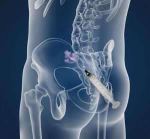 Sacroiliac Joint Injections