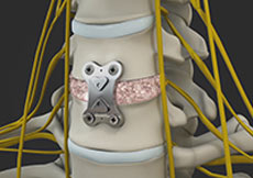Anterior Cervical Discectomy