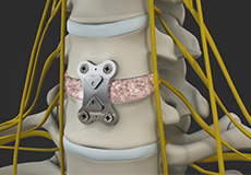 Anterior Cervical Discectomy and Fusion