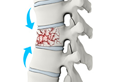 Compression Fractures