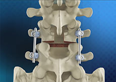 Lumbar Fusions