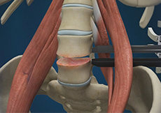 Lumbar Micro Discectomy