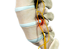 Lumbar stenosis