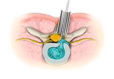 Minimally Invasive Surgeries