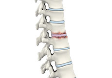 Osteoarthritis