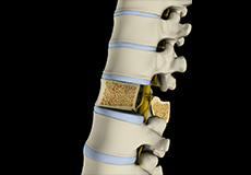 Osteoporosis