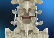 Posterior Lumbar Fusions