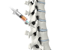 Spine Injections