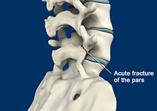 Spondylolisthesis Reduction & Fusion