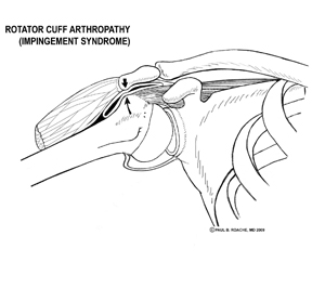 Impingement Syndrome