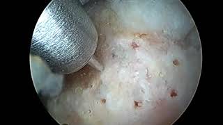 L sh Roache Awl 042018