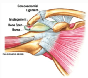 Rotator Cuff Impingement