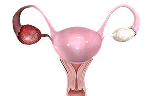 Ovarian Cysts