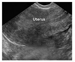 Pelvic Ultrasound
