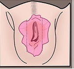 Plastic Vaginal Surgery
