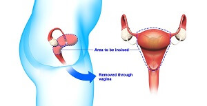 Annandale OB GYN - A Vaginal hysterectomy is a surgical procedure