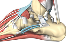 Ankle Ligament Reconstruction