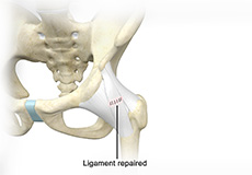 Ligament Preservation/Repair
