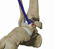 Osteochondral Allograft Transplantation System (OATS) of the Ankle