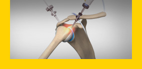 Minimally Invasive Surgical Options