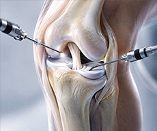 Arthroscopic Surgery