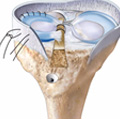 Meniscal Transplantation