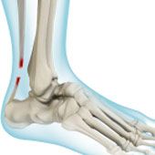 Achilles Tendon Rupture