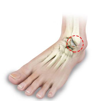 Foot and Ankle Arthritis