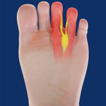 Morton’s Neuroma