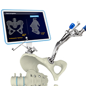 Computer Assisted Hip Arthroplasty