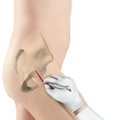 Minimally Invasive Total Hip Replacement