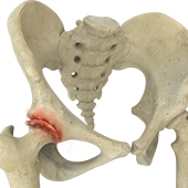 Osteoarthritis of the Hip