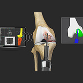 Partial Knee Replacement