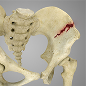 Pelvic Fractures