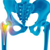Revision Total Hip Arthroplasty