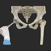 Robotic Total Hip Replacement