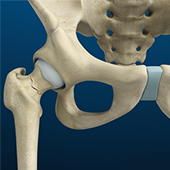 Stress Fractures of the Hip