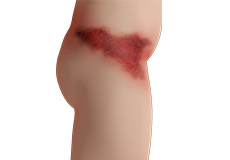 Contusions