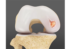 Osteochondral Lesions (OCD lesions)