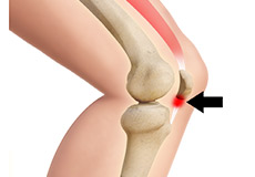Over Use Syndromes including quad and patella tendonitis