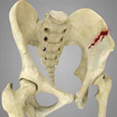 Pelvic fractures