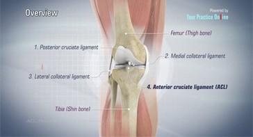 Picture of ACL Reconstruction Hamstring Method