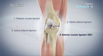 Picture of ACL Reconstruction Patellar Tendon