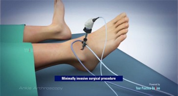 Picture of Ankle Arthroscopy