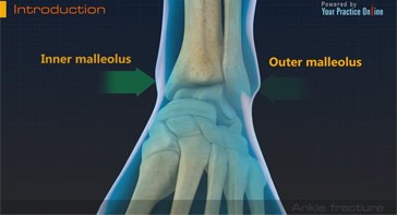 Picture of Ankle Fracture