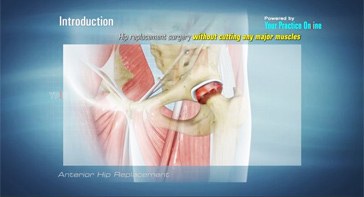 Picture of Anterior Hip Replacement