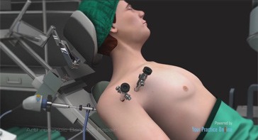 Picture of Arthroscopic Bankart Repair