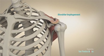 Picture of Arthroscopic Sub-acromial Decompression Surgery