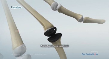 Picture of Artificial Finger Joint Replacement