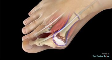Picture of Bunion Surgery